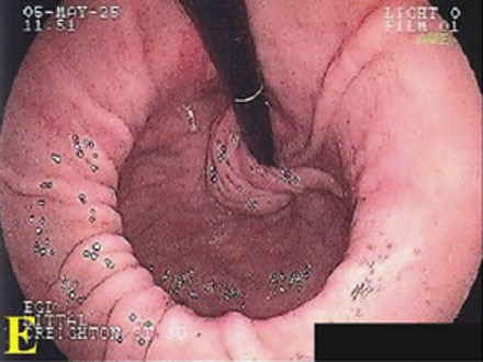 Resim 1. Endoskopide mide fıtığı görüntüsü