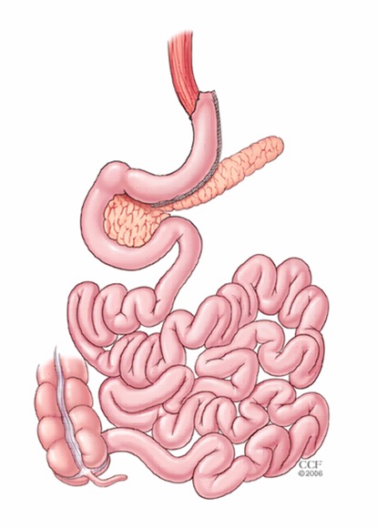 Şekil 1-Sleeve Gastrektomi (Tüp mide ameliyatı)  